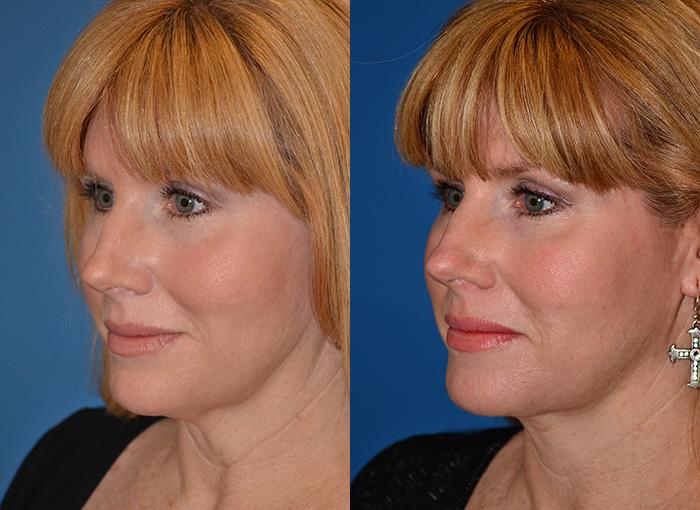 Laser Assisted Weekend Neck Lift Photos Melbourne, FL Patient 28409